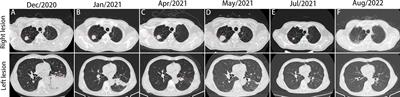Case Report: A case of synchronous right upper lobe adenocarcinoma and left lower lobe squamous cell carcinoma treated with immune checkpoint inhibitor plus chemotherapy